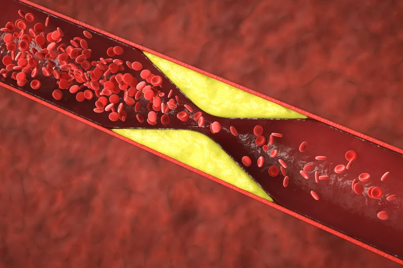blood clot